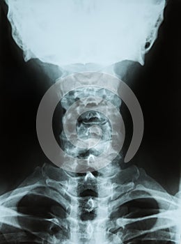 X-ray of a cervical spine(neck)
