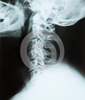 X-ray of a cervical spine(neck) of