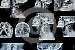 x-ray with cervical spine and paranasal sinuses photo