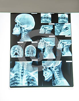 x-ray with cervical spine and paranasal sinuses photo