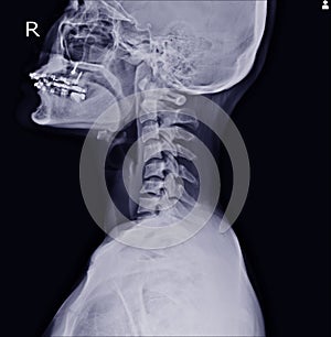 X-ray of the cervical spine showing Thoracic scoliosis with cervical spondylosis from C4-5 to C7-T1 photo