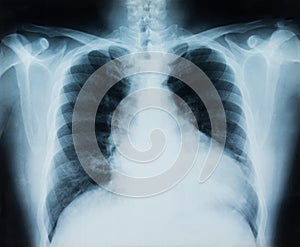 X-ray chest