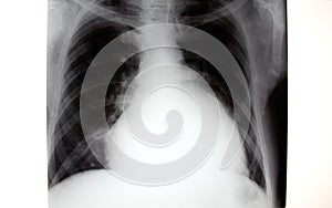 X-ray of chest, enlarged heart