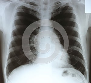 X-ray chest film