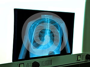 X-ray of chest heart stimulator