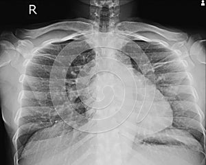 X-ray Chest LORDOTIC VIEW