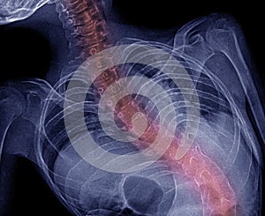 X-ray of the chest and lungs, S-shaped scoliotic deformity of the vertebral column