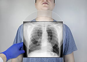 X-ray of the chest of a man. A doctor radiologist is studying an x-ray examination. A picture of the organs of the chest cavity is