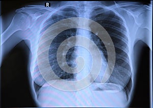Chest x-ray