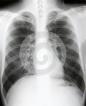 X-ray of chest of patient