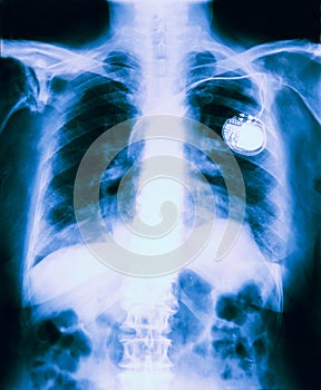 X Ray Of Chest Showing Pacemaker Fitted photo