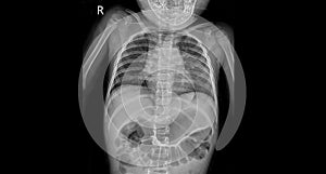 X-ray of children with common cold or pneumonia.Child health education.Normal x-ray in children