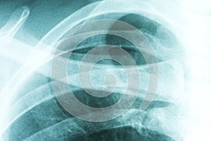 X-Ray Of Collar Bone