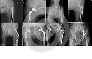 X-ray Collection orthopedic surgery Multiple hip human, operate and internal fixation by plate and