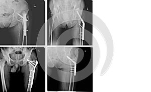 X-ray Collection orthopedic surgery Multiple hip human, operate and internal fixation by plate and