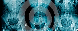 X-ray collection pelvic bone and thraco-lumbar spine