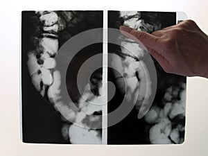 X-ray of colon