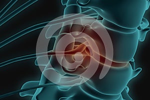 X-ray 3d image of cervical spine with prolapse of intervertebral disc compressive nerve root photo