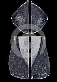 X-ray Digital Mammogram or mammography of both side breast CC view and MLO