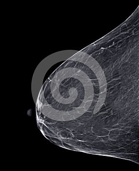 X-ray Digital Mammogram or mammography of both side breast CC view and MLO