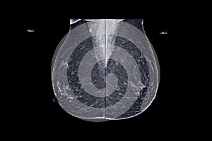 X-ray Digital Mammogram  or mammography  both side of the breast  MLO view  for diagnonsis Breast cancer in women isolated on