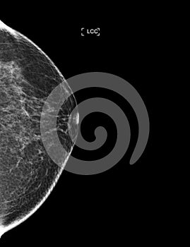 X-ray Digital Mammogram or mammography of both side breast showing benign tumor BI-RADS 2 should be checked once a year