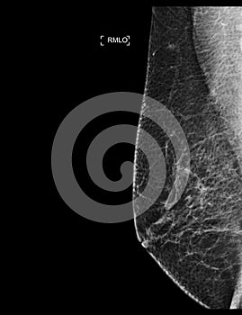 X-ray Digital Mammogram or mammography of both side breast showing benign tumor BI-RADS 2 should be checked once a year