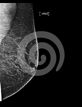 X-ray Digital Mammogram or mammography of both side breast showing benign tumor BI-RADS 2 should be checked once a year