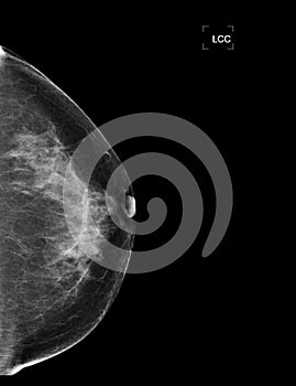 X-ray Digital Mammogram or mammography of both side breast showing benign tumor BI-RADS 2 should be checked once a year