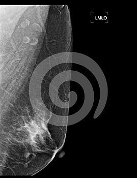 X-ray Digital Mammogram or mammography of both side breast showing benign tumor BI-RADS 2 should be checked once a year