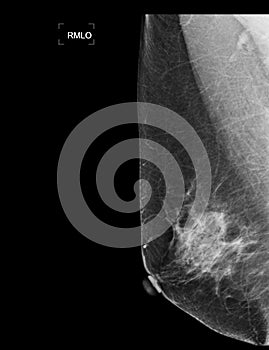 X-ray Digital Mammogram or mammography of both side breast showing benign tumor BI-RADS 2 should be checked once a year