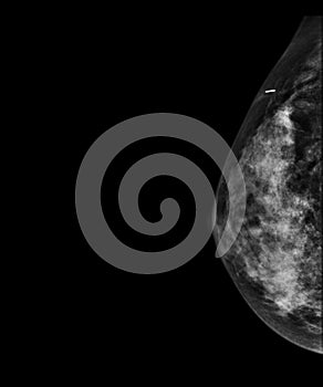 X-ray Digital Mammogram or mammography of both side breast showing benign tumor BI-RADS 2 should be checked once a year