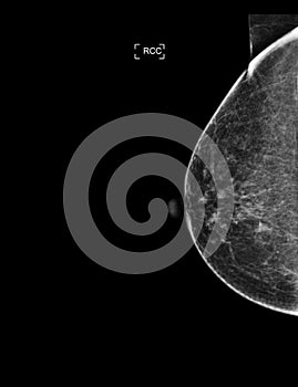 X-ray Digital Mammogram or mammography of both side breast showing Normal breast BI-RADS 1 should be checked once a year