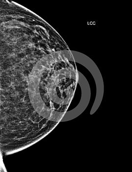 X-ray Digital Mammogram or mammography of both side breast Standard views are bilateral craniocaudal (CC