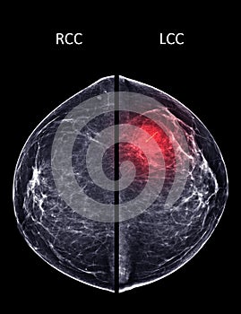 X-ray Digital Mammogram or mammography of both side breast Standard views are bilateral craniocaudal (CC