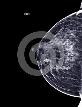 X-ray Digital Mammogram or mammography of both side breast Standard views are bilateral craniocaudal (CC