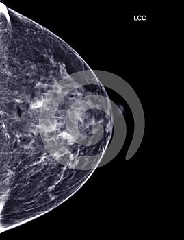 X-ray Digital Mammogram or mammography of both side breast Standard views are bilateral craniocaudal (CC