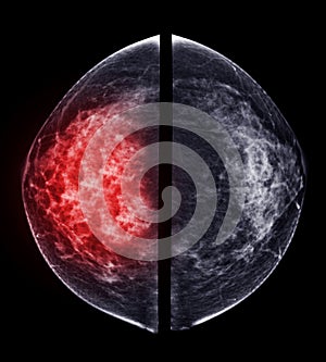 X-ray Digital Mammogram or mammography of both side breast Standard views are bilateral craniocaudal (CC