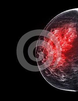 X-ray Digital Mammogram or mammography of both side breast Standard views are bilateral craniocaudal (CC