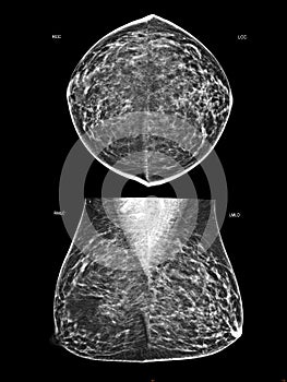 X-ray Digital Mammogram or mammography of both side breast Standard views are bilateral craniocaudal (CC