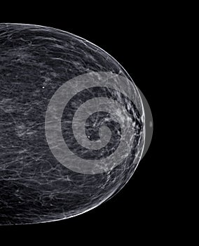 X-ray Digital Mammogram or mammography of both side breast Standard views are bilateral craniocaudal (CC