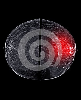 X-ray Digital Mammogram or mammography of both side breast Standard views are bilateral craniocaudal (CC