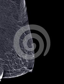 X-ray Digital Mammogram or mammography of both side breast Standard views are  mediolateral oblique (MLO) views