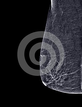 X-ray Digital Mammogram or mammography of both side breast Standard views are  mediolateral oblique (MLO) views