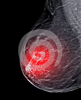 X-ray Digital Mammogram or mammography of both side breast Standard views are  mediolateral oblique (MLO) views