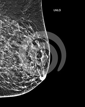 X-ray Digital Mammogram or mammography of both side breast Standard views are  mediolateral oblique (MLO) views
