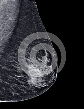 X-ray Digital Mammogram or mammography of both side breast Standard views are  mediolateral oblique (MLO) views