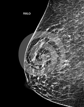 X-ray Digital Mammogram or mammography of both side breast Standard views are  mediolateral oblique (MLO) views