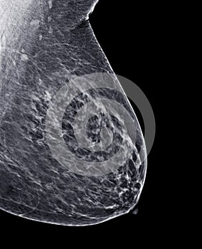 X-ray Digital Mammogram or mammography of both side breast Standard views are  mediolateral oblique (MLO) views