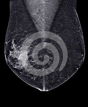 X-ray Digital Mammogram or mammography of both side breast Standard views are  mediolateral oblique (MLO) views